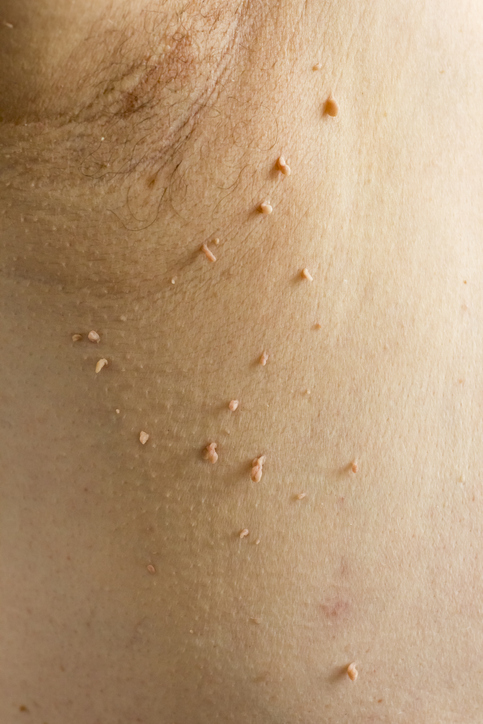 Papilloma virus in the human armpit, the concept of skin disease